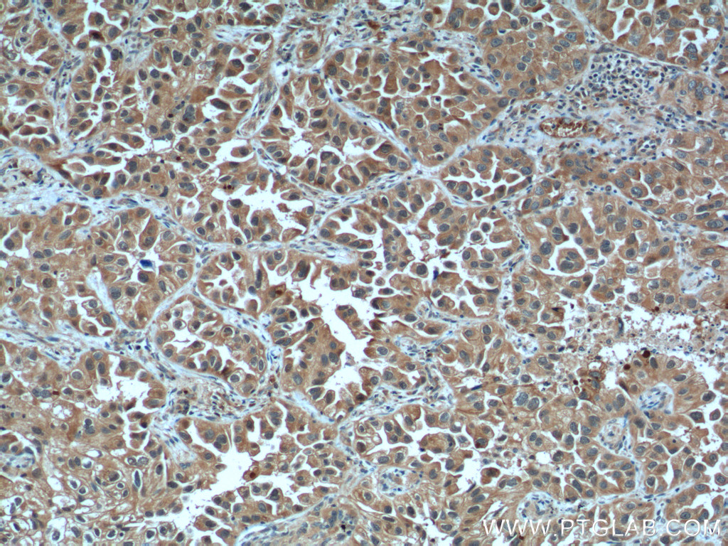 IHC staining of human lung cancer using 26757-1-AP