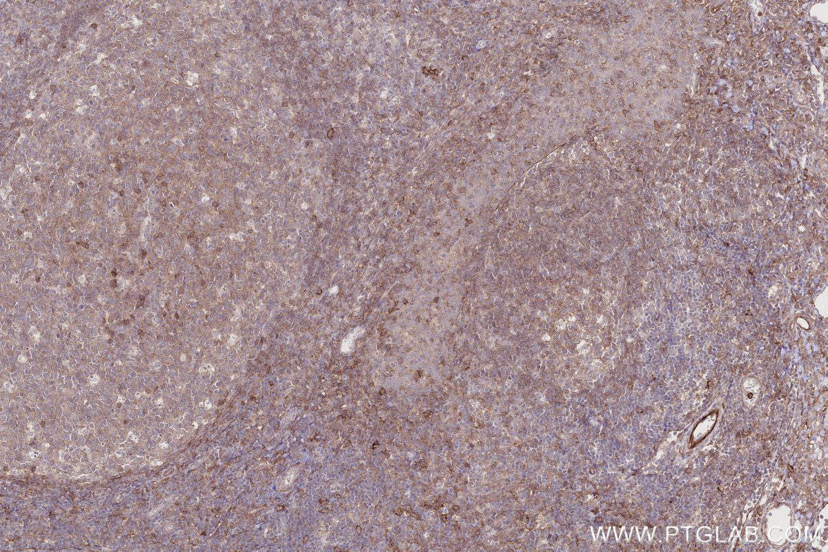 IHC staining of human tonsillitis using 26455-1-AP IHC staining of human tonsillitis using 26455-1-AP