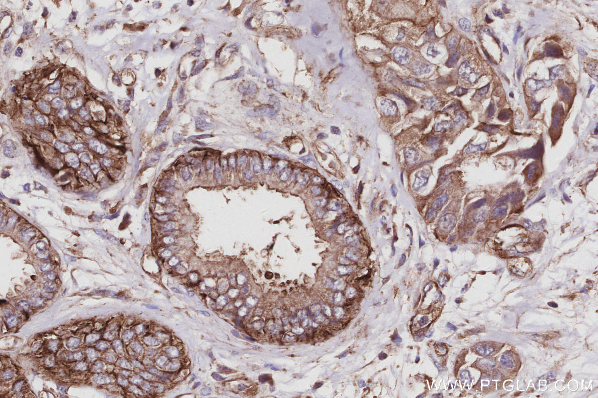IHC staining of human pancreas cancer using 16639-1-AP IHC staining of human pancreas cancer using 16639-1-AP