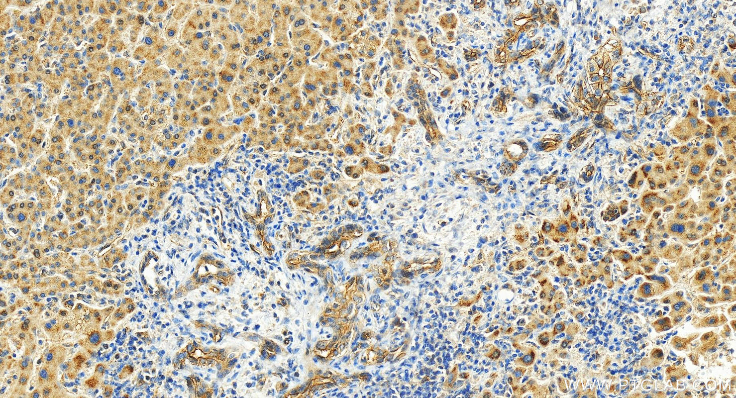 IHC staining of human intrahepatic cholangiocarcinoma using 26561-1-AP