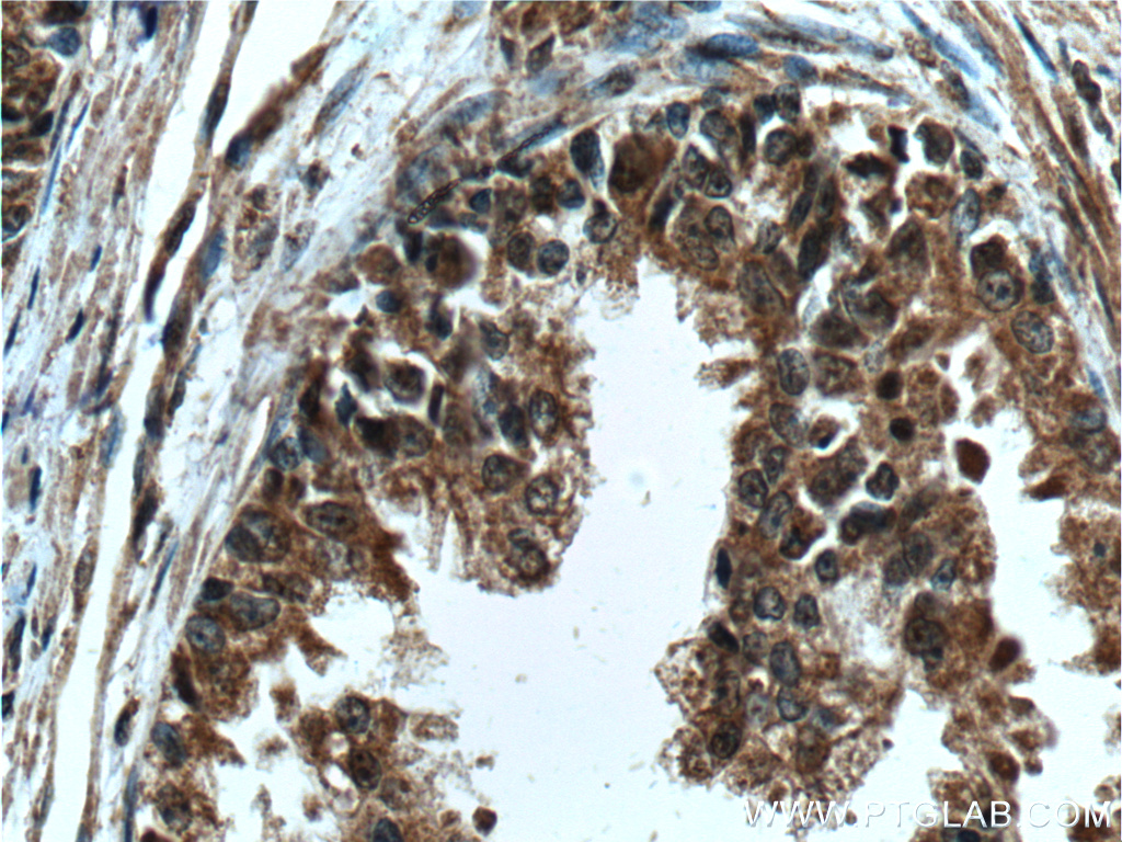 IHC staining of human prostate cancer using 60344-1-Ig (same clone as 60344-1-PBS)