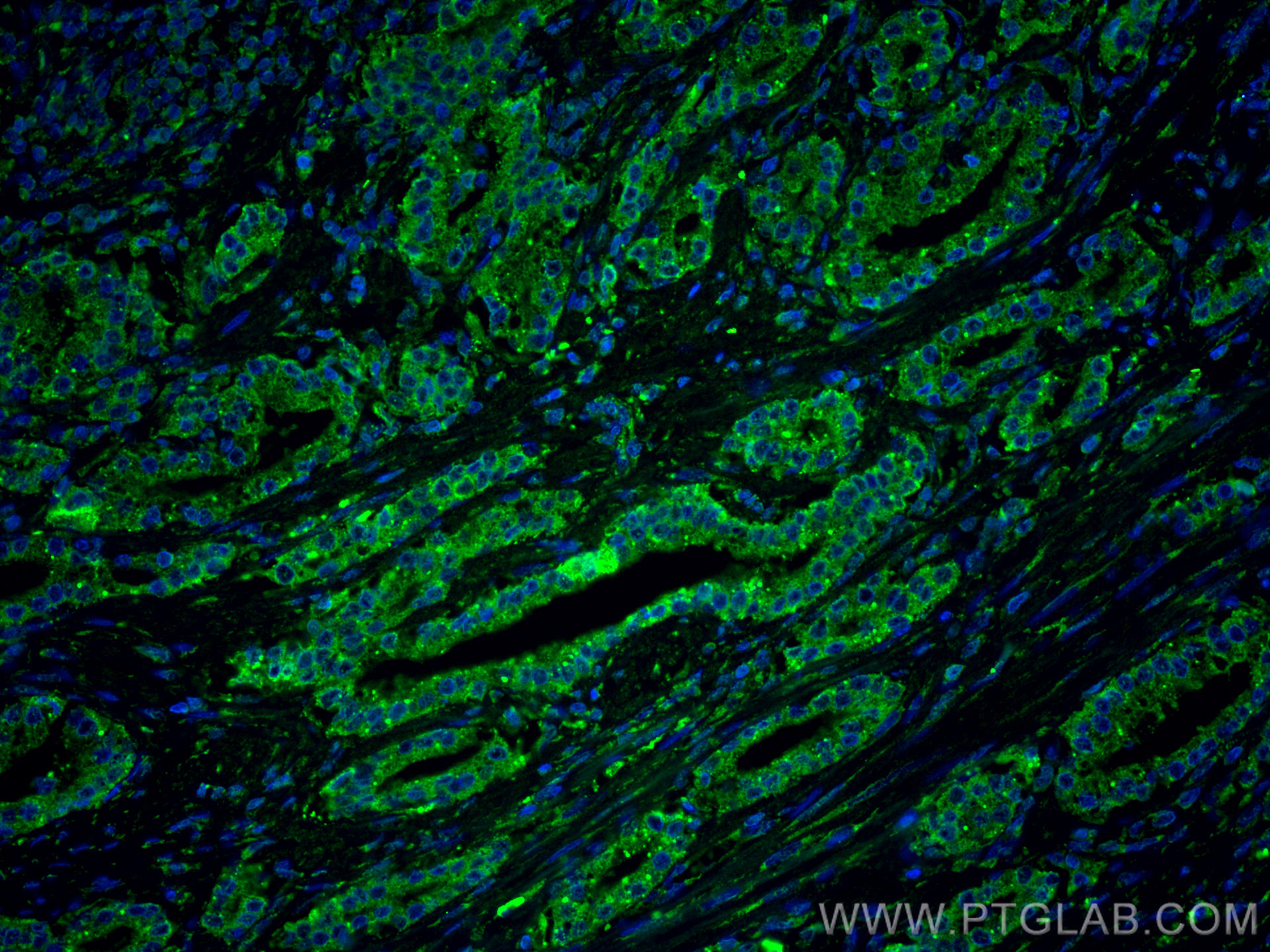 IF Staining of human prostate cancer using CL488-60344