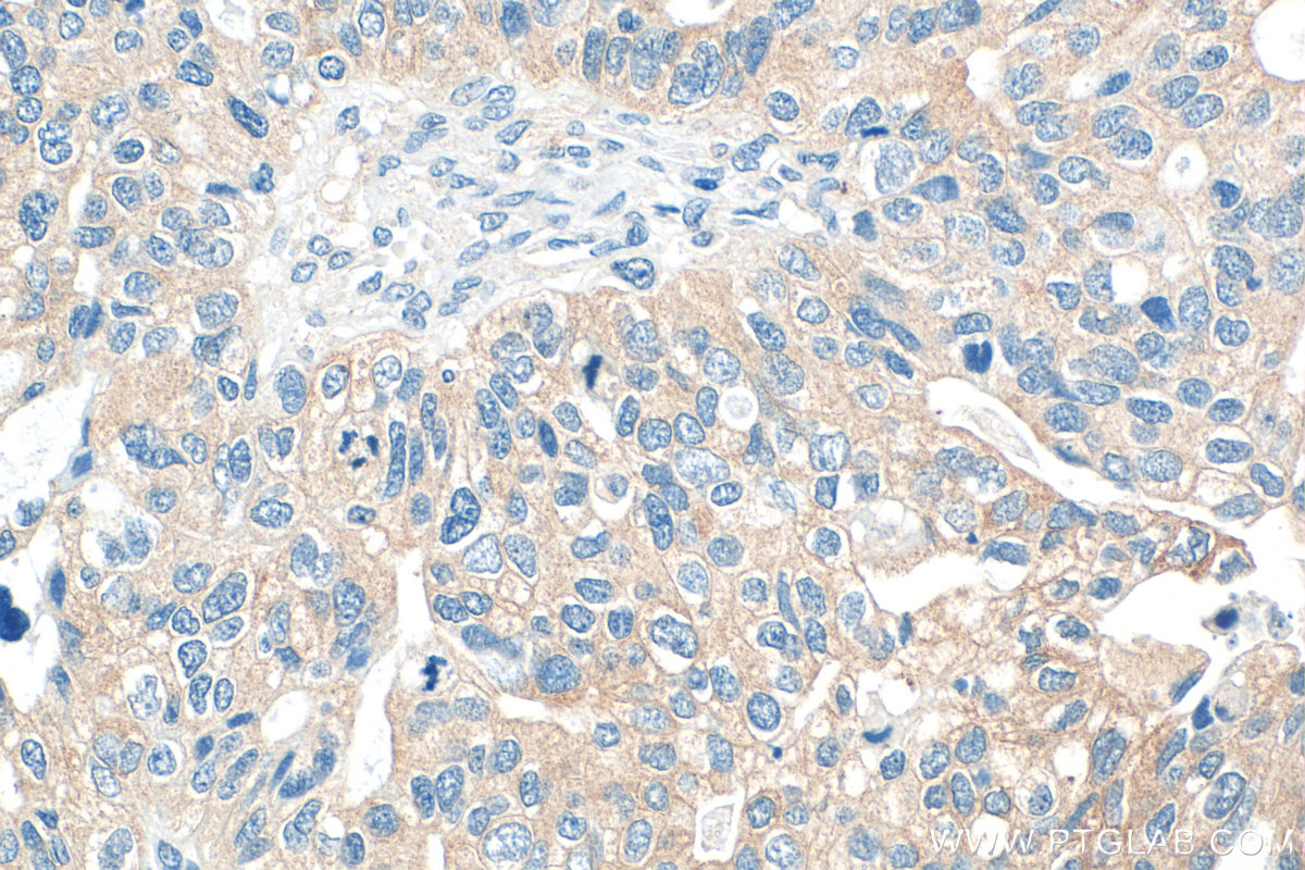 Immunohistochemical analysis of paraffin-embedded human ovary tumor tissue slide using 24017-1-AP (LIN28B antibody) at dilution of 1:200 (under 40x lens). Heat mediated antigen retrieval with Tris-EDTA buffer (pH 9.0). IHC staining of human ovary tumor using 24017-1-AP