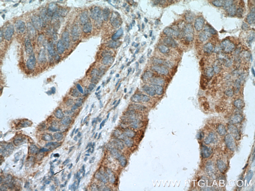IHC staining of human colon cancer using 12956-1-AP