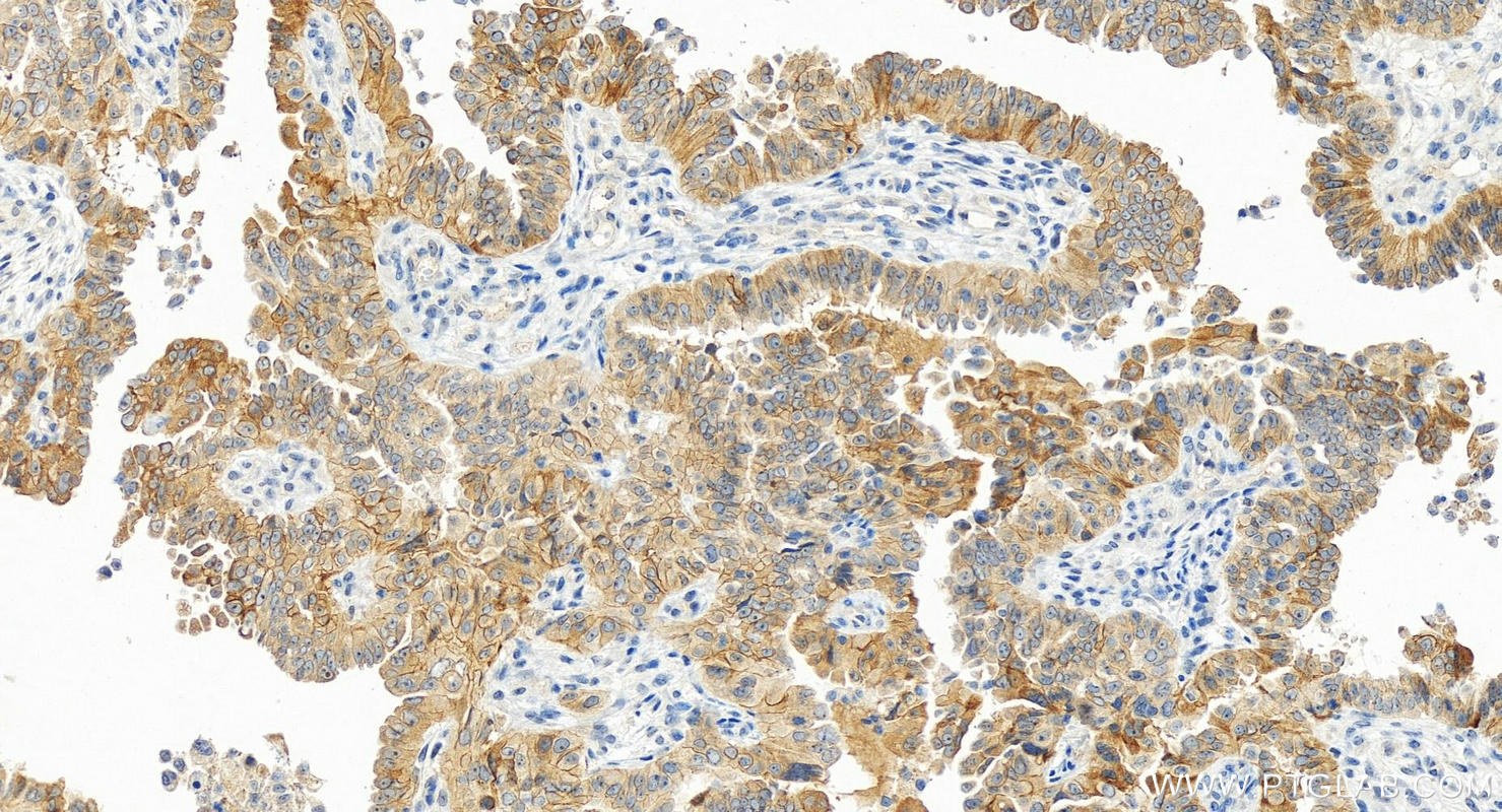 Immunohistochemical analysis of paraffin-embedded human ovarian cancer slide using 15993-1-AP (LLGL2 antibody) at dilution of 1:400 (under 20x lens). Heat mediated antigen retrieval with Tris-EDTA buffer (pH 9.0). IHC staining of human ovarian cancer using 15993-1-AP