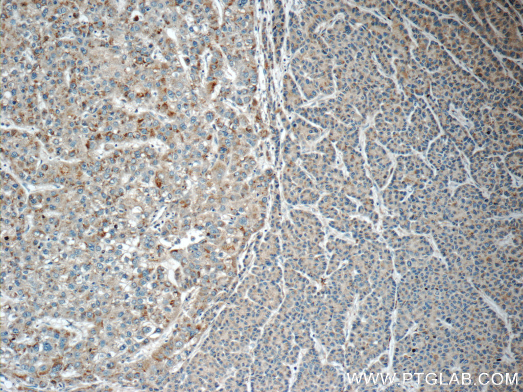 IHC staining of human liver cancer using 16812-1-AP