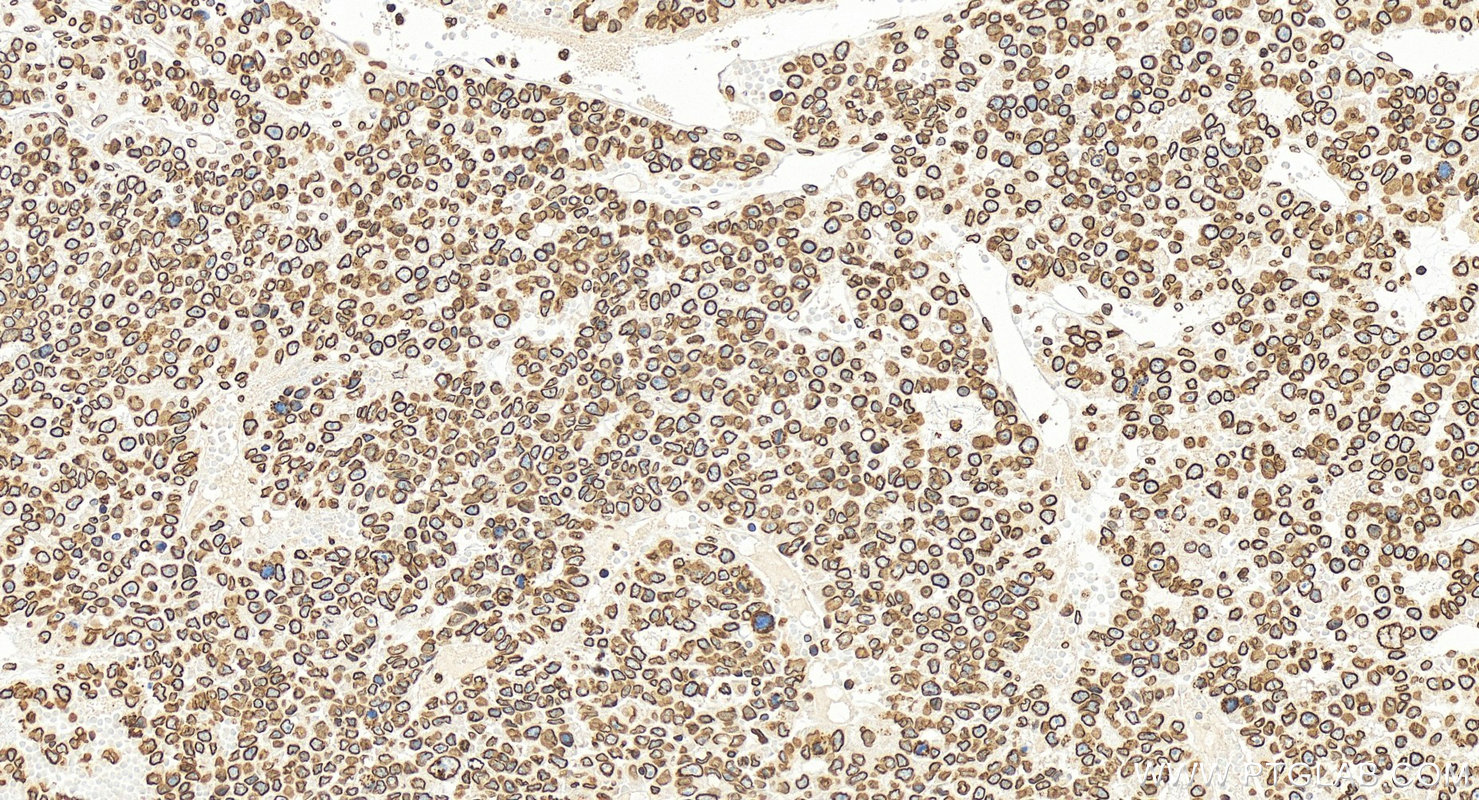 Immunohistochemical analysis of paraffin-embedded human hepatocellular carcinoma slide using 12987-1-AP (Lamin B1 antibody) at dilution of 1:2000 (under 20x lens). Heat mediated antigen retrieval with Sodium Citrate buffer (pH 6.0). IHC staining of human hepatocellular carcinoma using 12987-1-AP