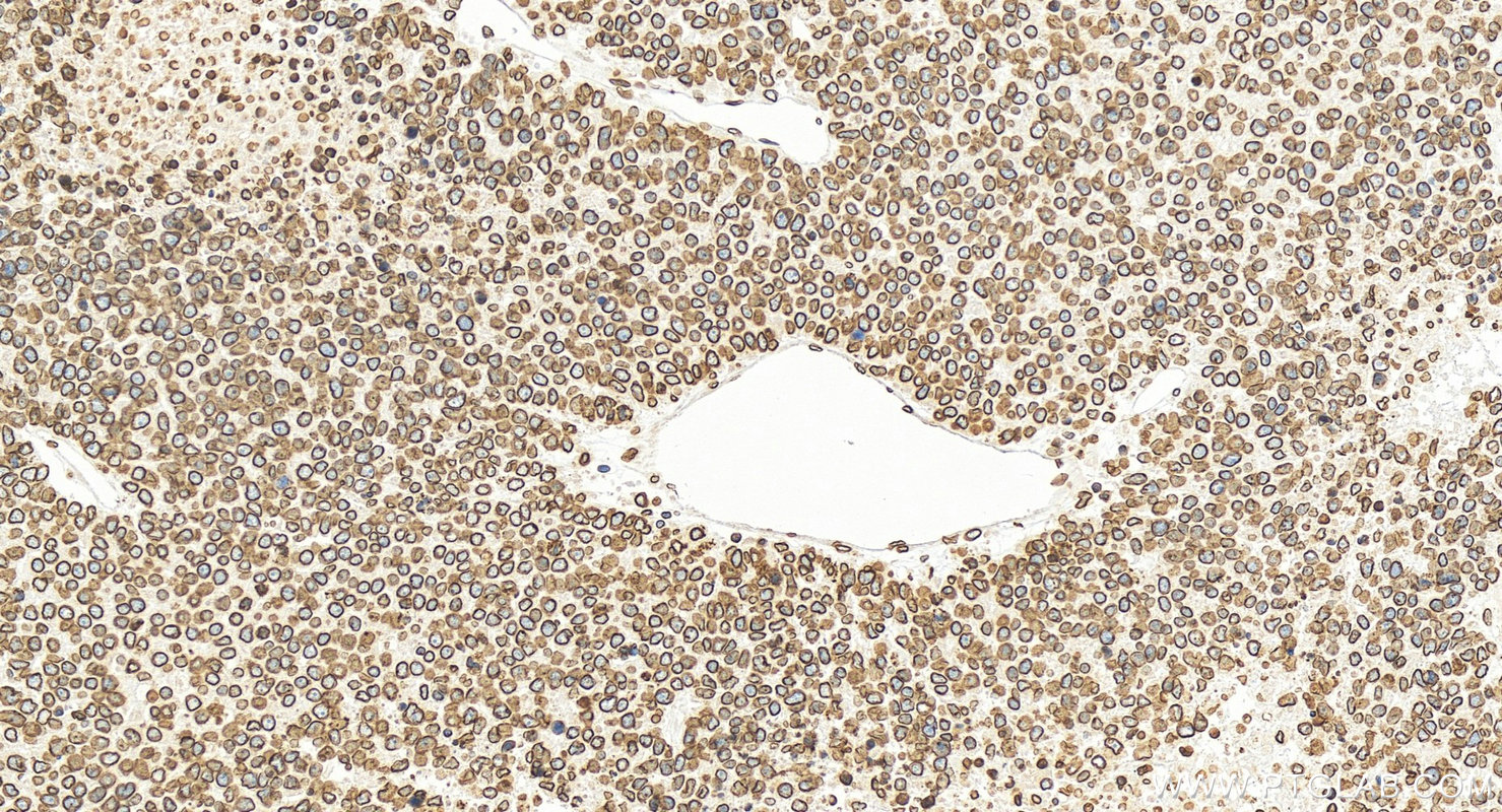 Immunohistochemical analysis of paraffin-embedded human hepatocellular carcinoma slide using 12987-1-AP (Lamin B1 antibody) at dilution of 1:2000 (under 20x lens). Heat mediated antigen retrieval with Sodium Citrate buffer (pH 6.0). IHC staining of human hepatocellular carcinoma using 12987-1-AP