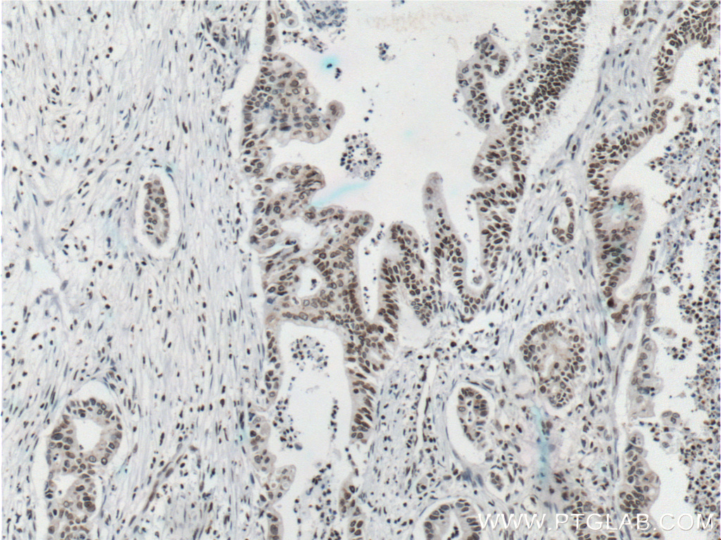 IHC staining of human pancreas cancer using 66095-1-Ig (same clone as 66095-1-PBS)