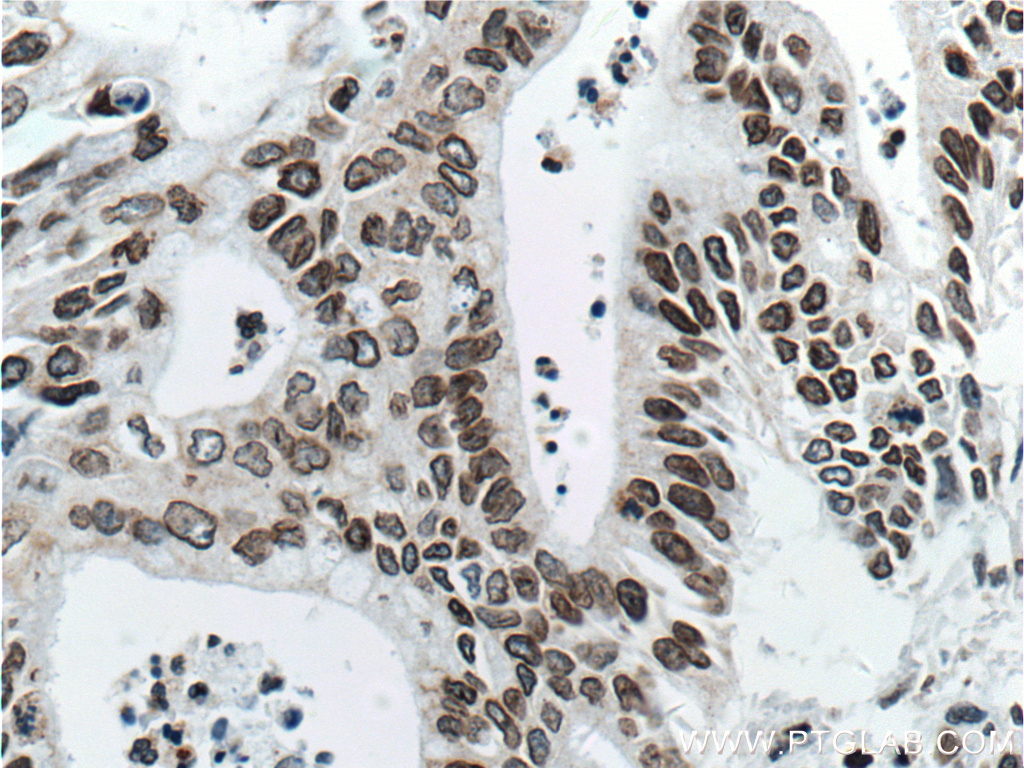IHC staining of human pancreas cancer using 66095-1-Ig