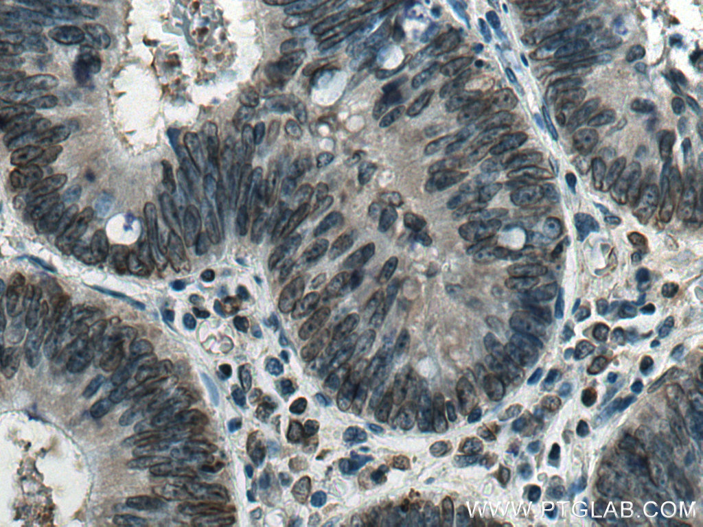 IHC staining of human colon cancer using 10895-1-AP