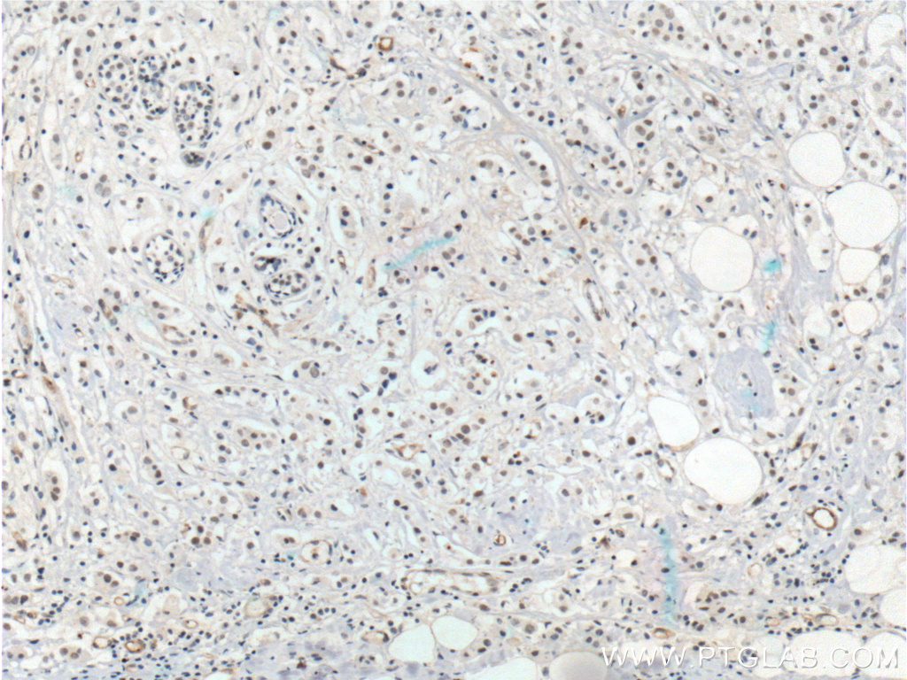IHC staining of human breast cancer using 22899-1-AP