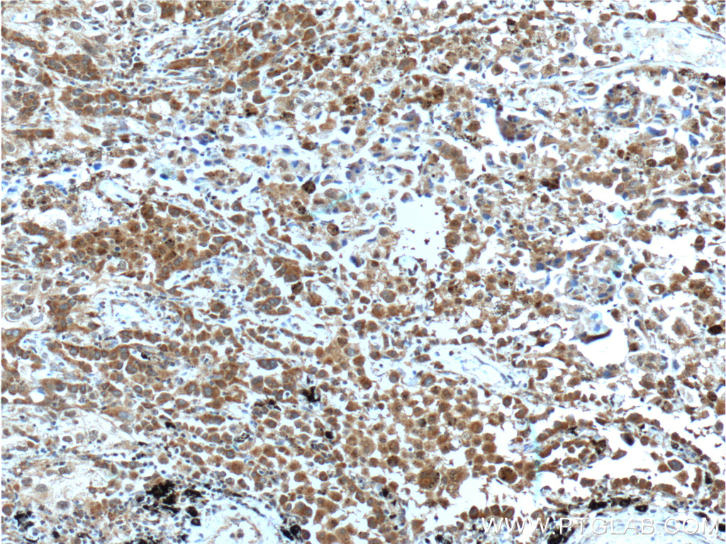 IHC staining of human lung cancer using 22899-1-AP
