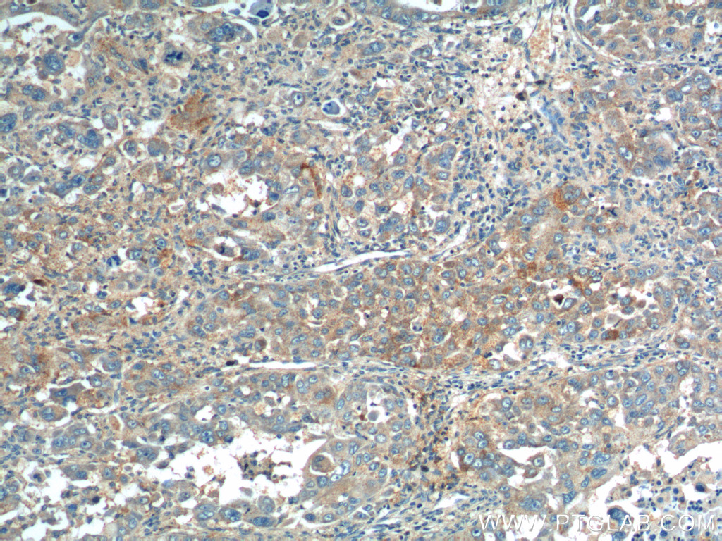 IHC staining of human liver cancer using 23792-1-AP