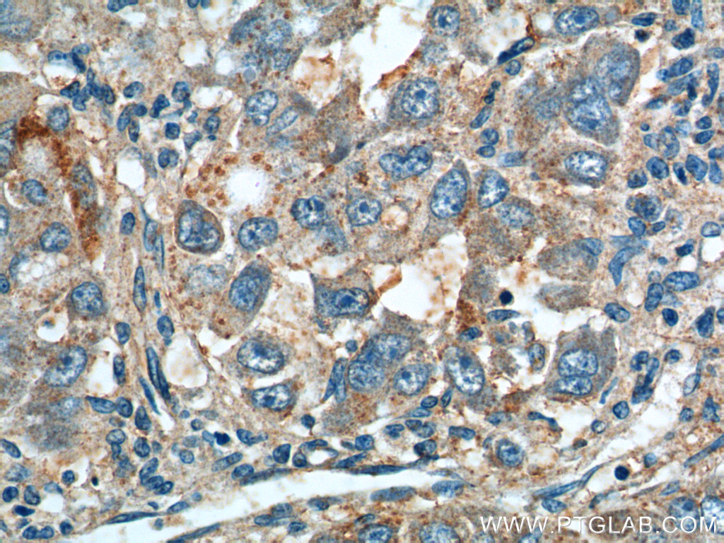 IHC staining of human liver cancer using 23792-1-AP