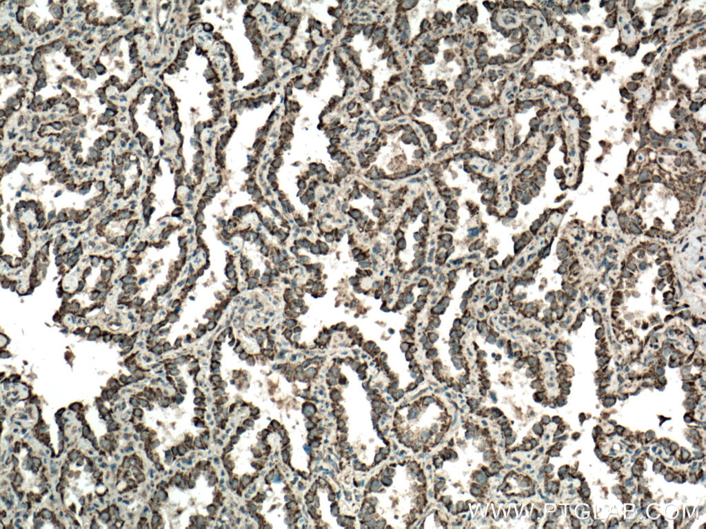 IHC staining of human lung cancer using 15440-1-AP