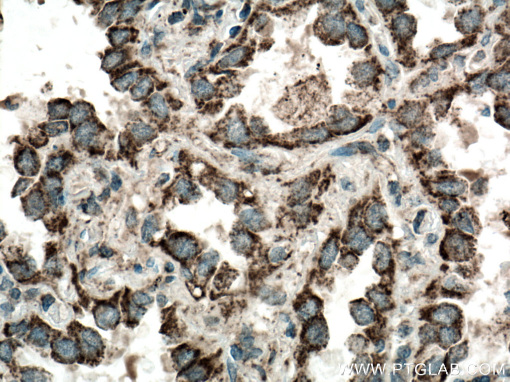 IHC staining of human lung cancer using 15440-1-AP