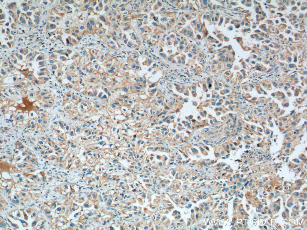 IHC staining of human lung cancer using 66043-1-Ig (same clone as 66043-1-PBS)