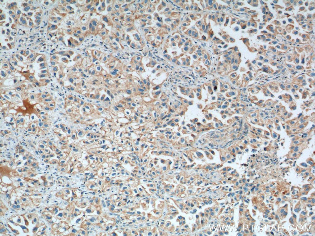 IHC staining of human lung cancer using 66043-1-Ig