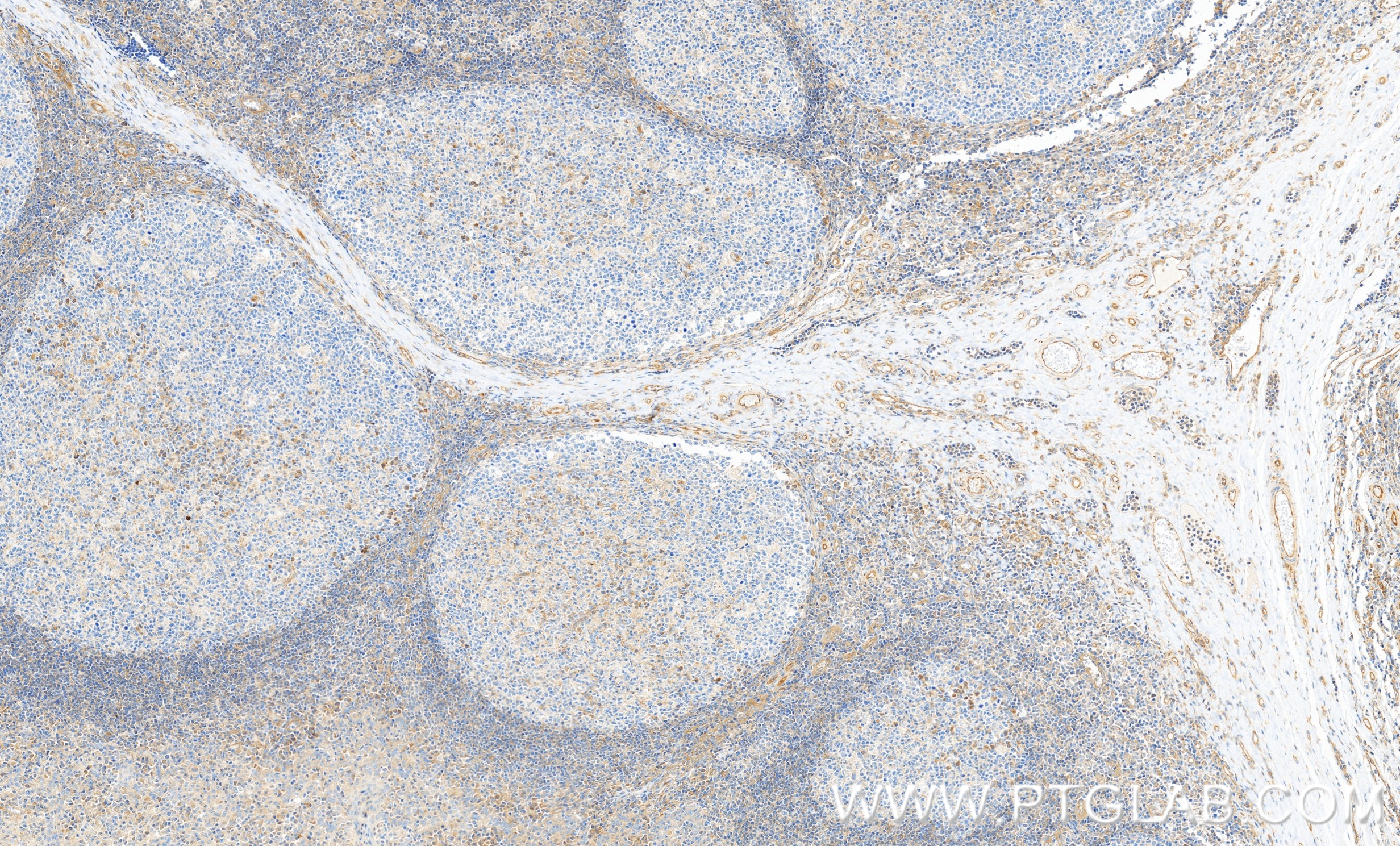 IHC staining of human tonsillitis using 86534-2-RR
