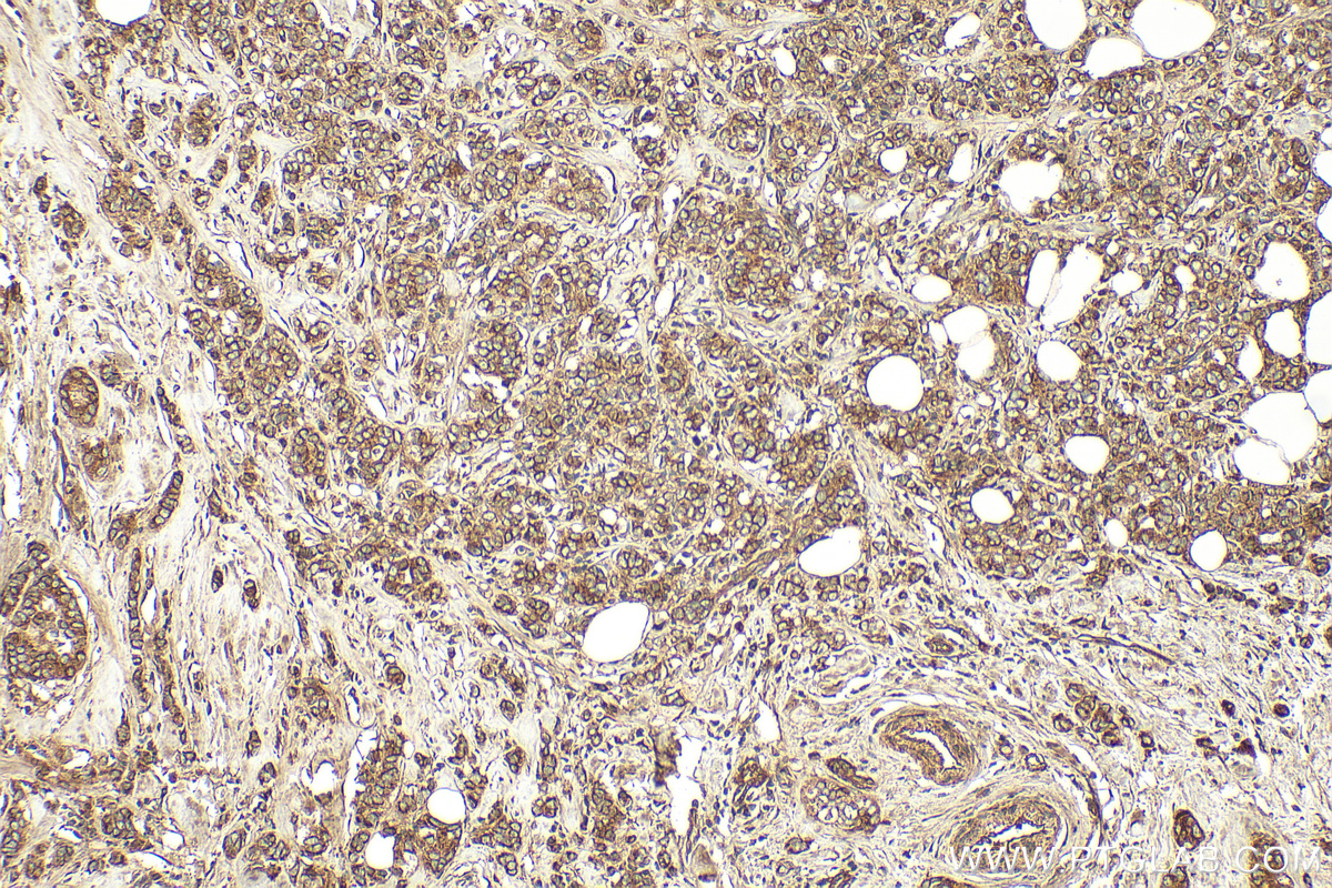 IHC staining of human breast cancer using 15232-1-AP
