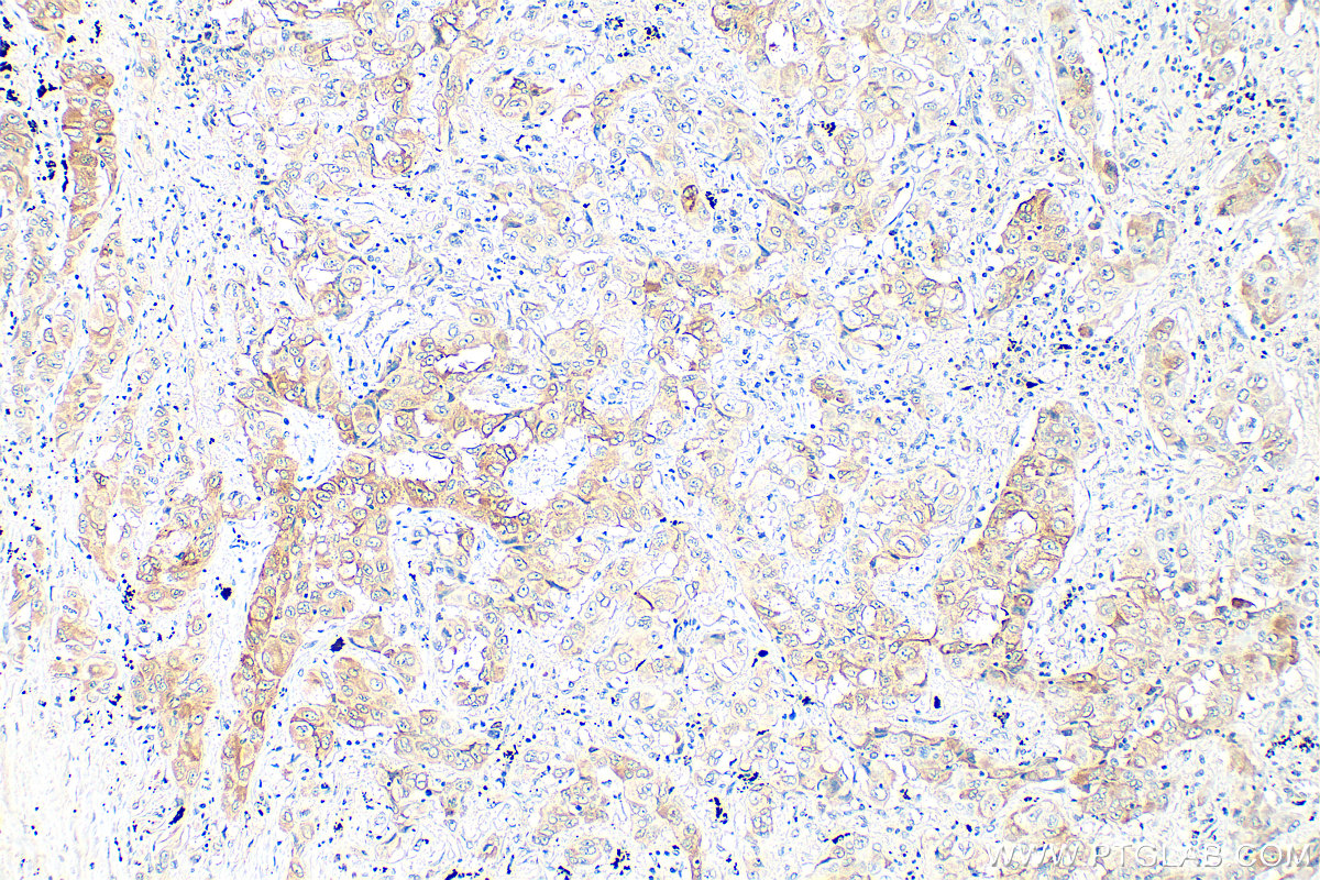 IHC staining of human lung cancer using 66044-1-Ig (same clone as 66044-1-PBS) IHC staining of human lung cancer using 66044-1-Ig (same clone as 66044-1-PBS)