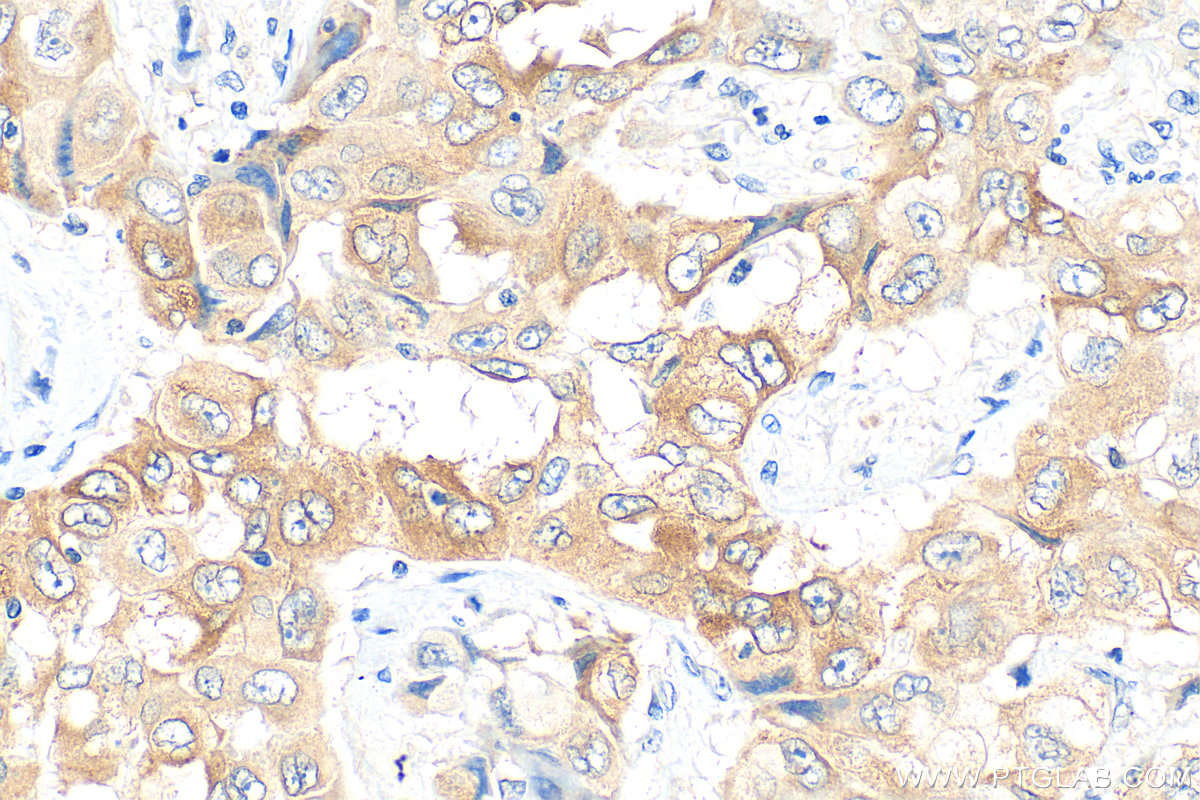 IHC staining of human lung cancer using 66044-1-Ig (same clone as 66044-1-PBS) IHC staining of human lung cancer using 66044-1-Ig (same clone as 66044-1-PBS)
