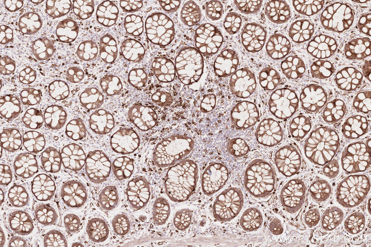 IHC staining of human rectal cancer using 15082-1-AP