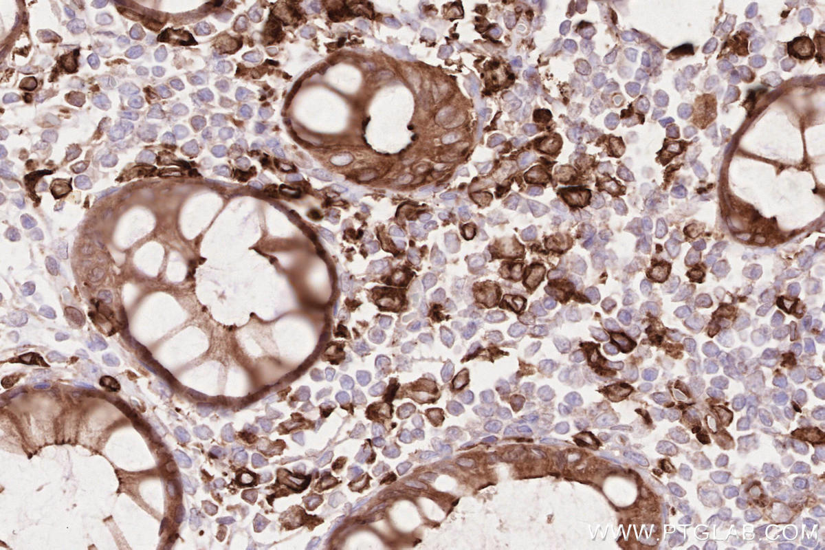 IHC staining of human rectal cancer using 15082-1-AP
