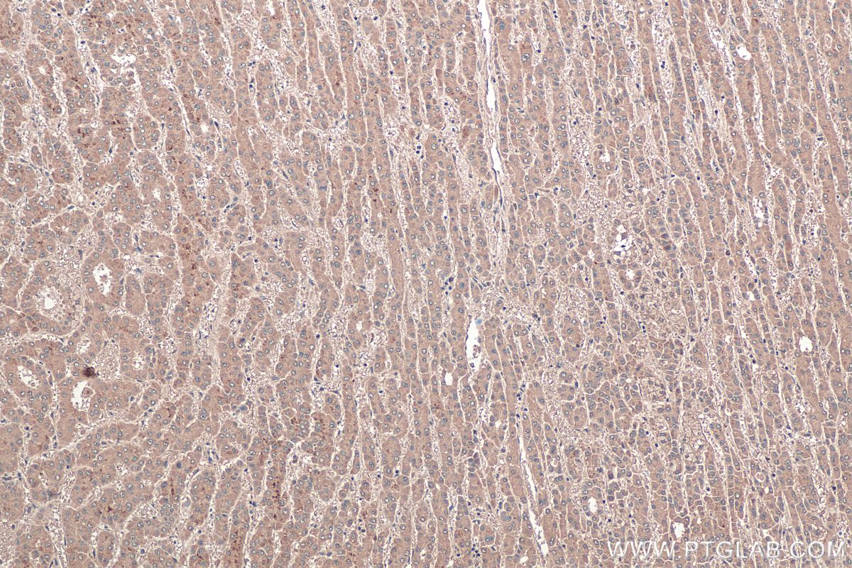 IHC staining of human liver cancer using 68124-1-Ig