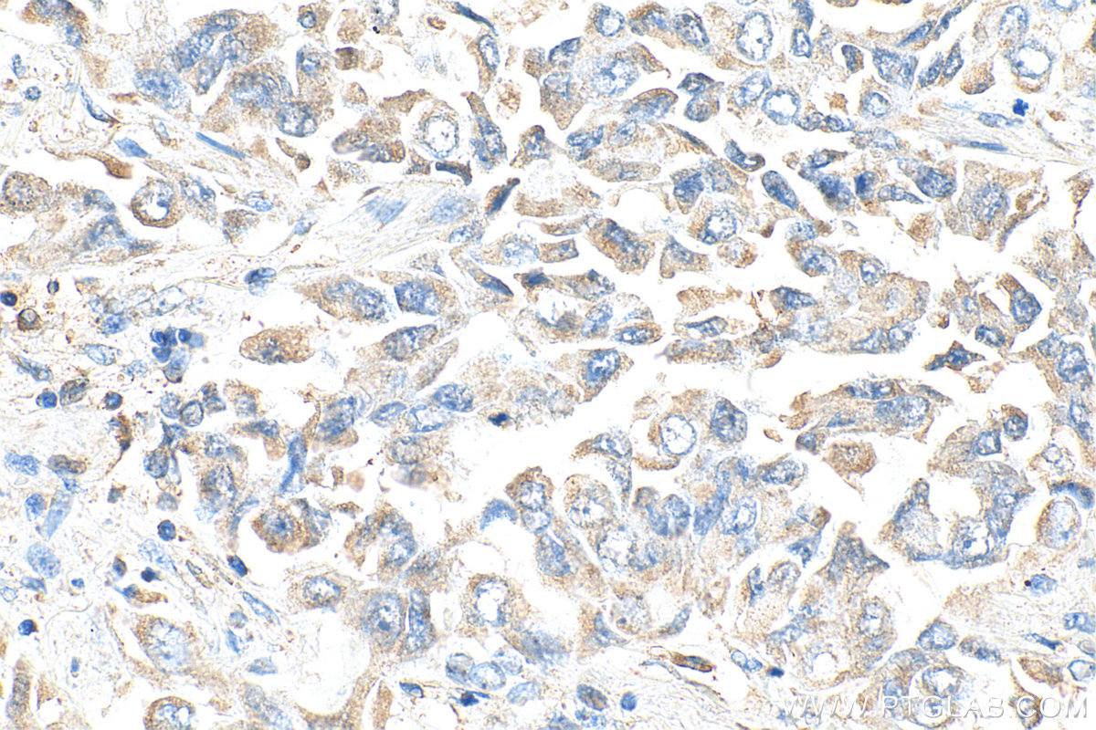 IHC staining of human lung cancer using 11307-1-AP