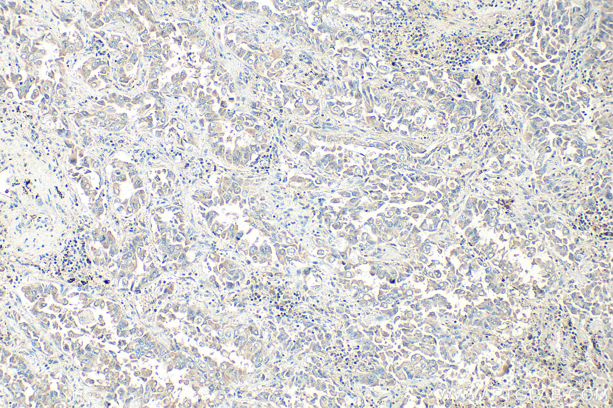 IHC staining of human lung cancer using 11307-1-AP