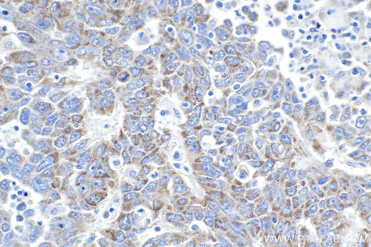 IHC staining of human lung cancer using 12119-1-AP
