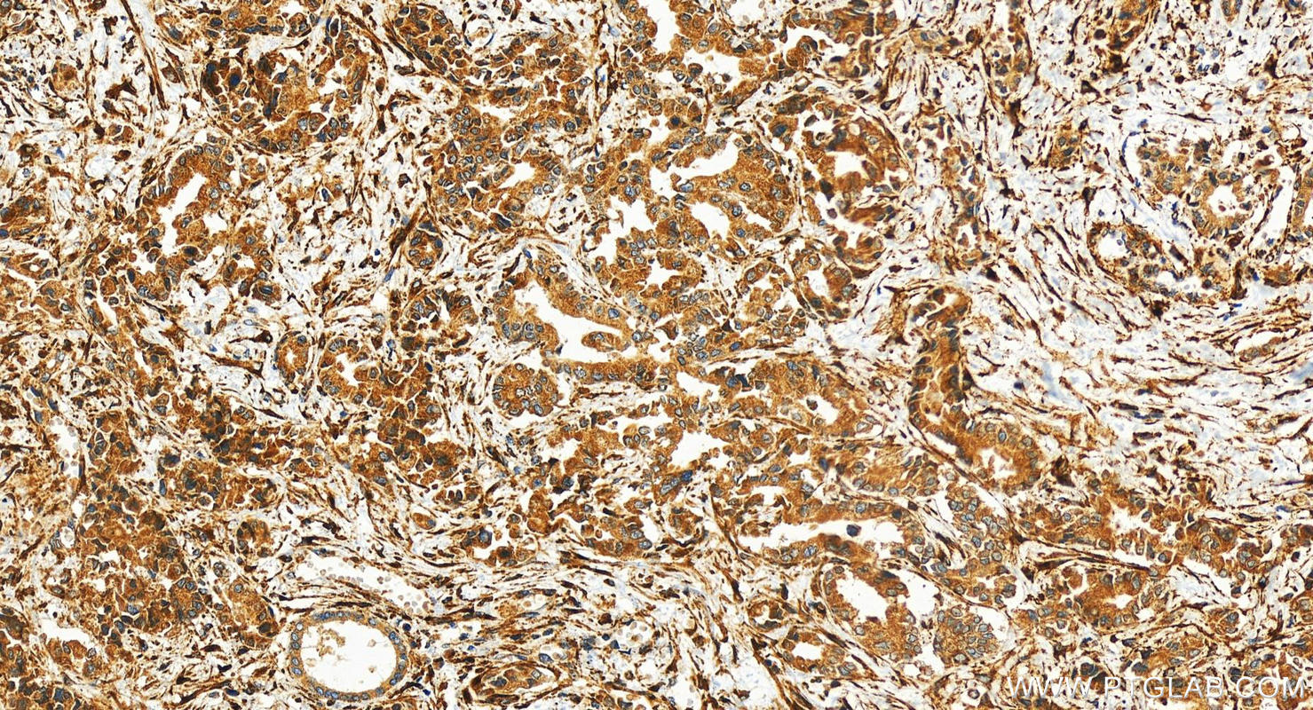 IHC staining of human intrahepatic cholangiocarcinoma using 30206-1-AP