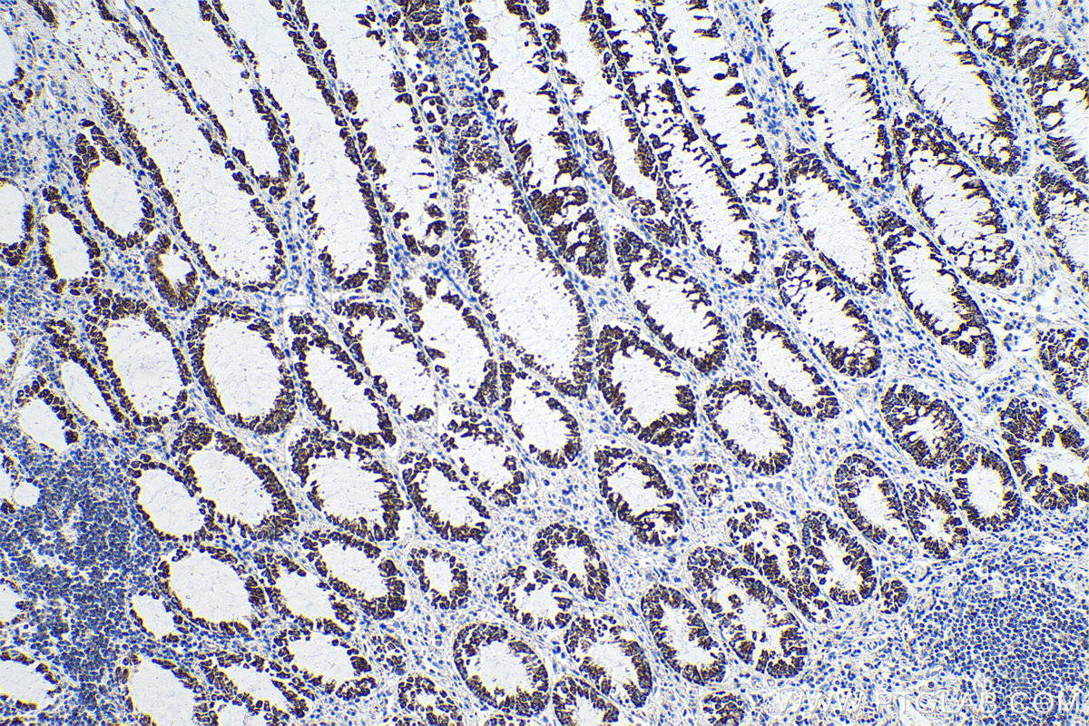 IHC staining of human colon cancer using 67679-1-Ig