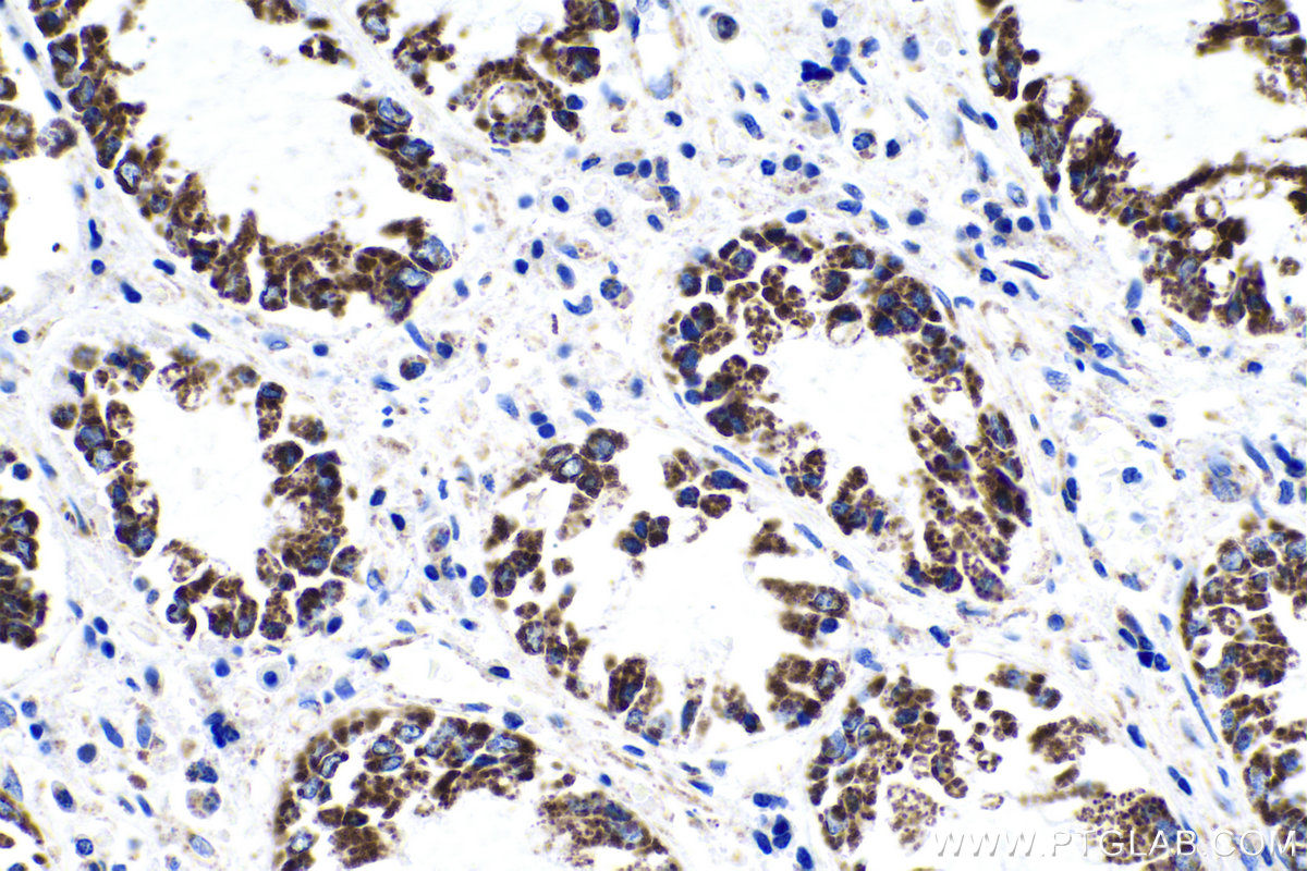IHC staining of human colon cancer using 67679-1-Ig