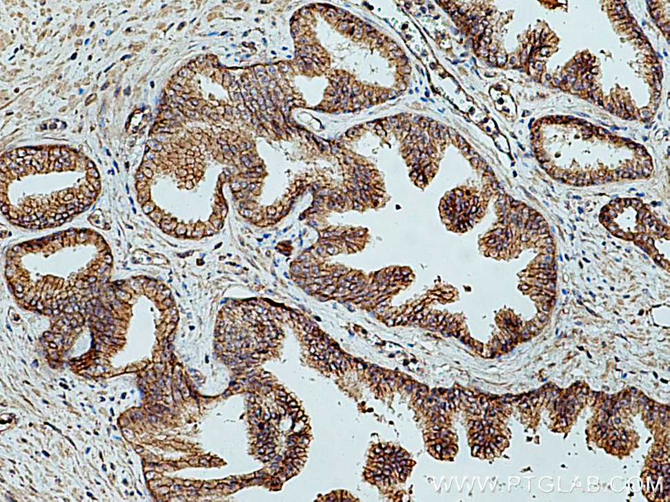 IHC staining of human prostate cancer using 10128-2-AP