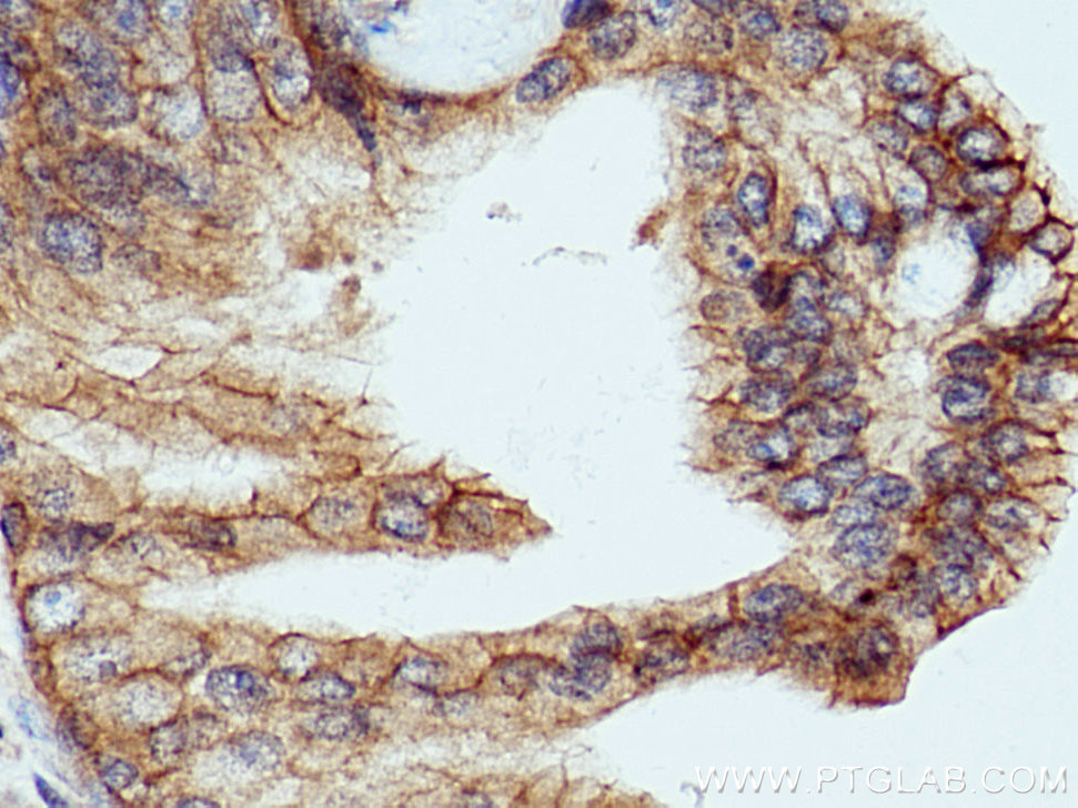 IHC staining of human prostate cancer using 10128-2-AP