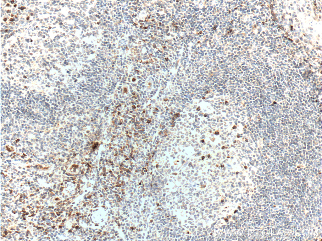 IHC staining of human tonsillitis using 26021-1-AP