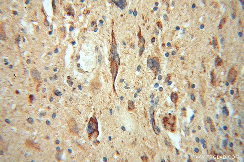 IHC staining of human gliomas using 13845-1-AP