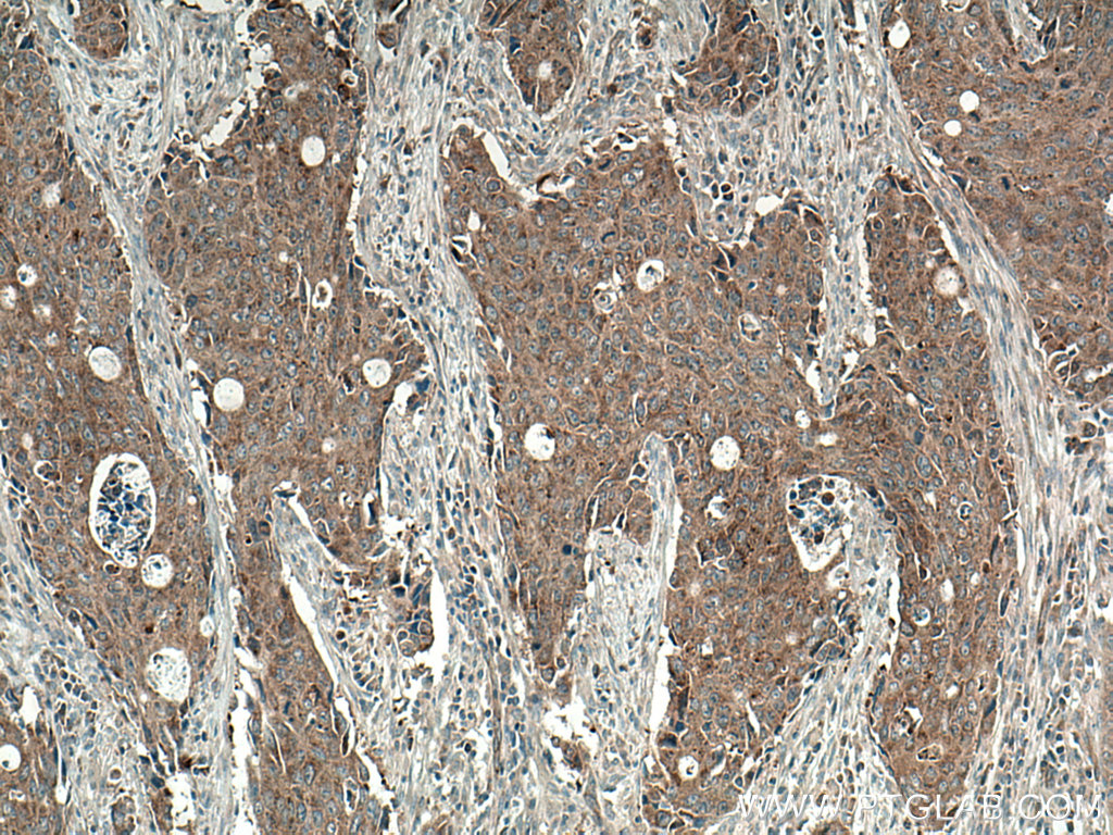 IHC staining of human colon cancer using 17155-1-AP