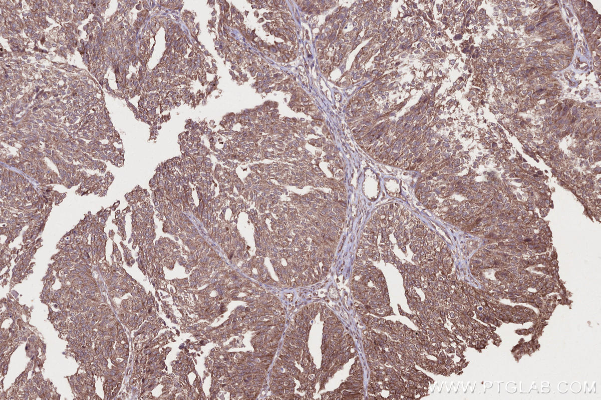 IHC staining of human ovary cancer using 18336-1-AP IHC staining of human ovary cancer using 18336-1-AP