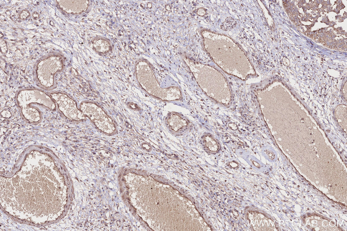 IHC staining of human ovary cancer using 18336-1-AP IHC staining of human ovary cancer using 18336-1-AP