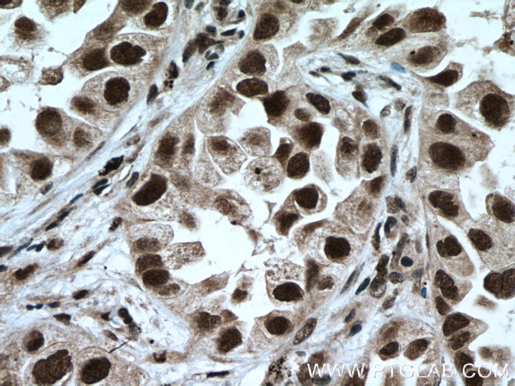 IHC staining of human lung cancer using 10834-1-AP