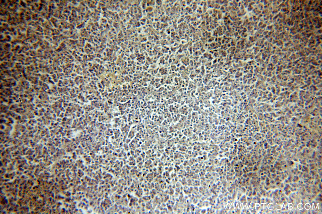 IHC staining of human lymphoma using 18941-1-AP (same clone as 18941-1-PBS)
