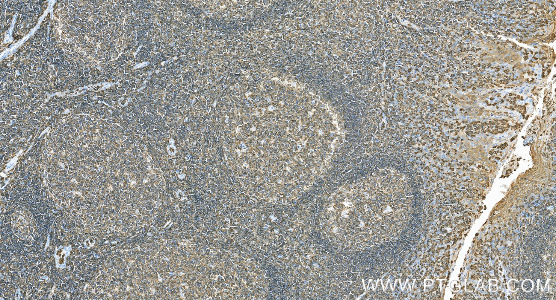 IHC staining of human tonsillitis using 87378-1-RR