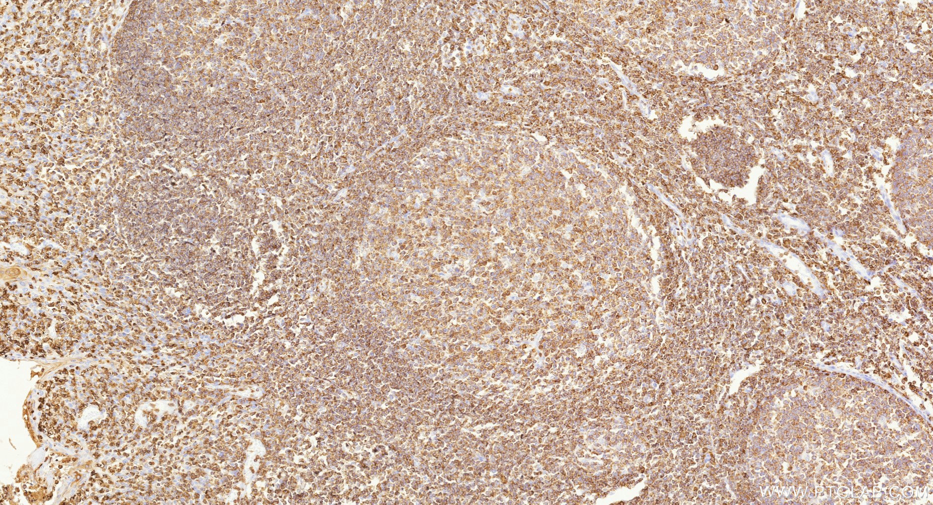 IHC staining of human tonsillitis using Biotin-87378 IHC staining of human tonsillitis using Biotin-87378