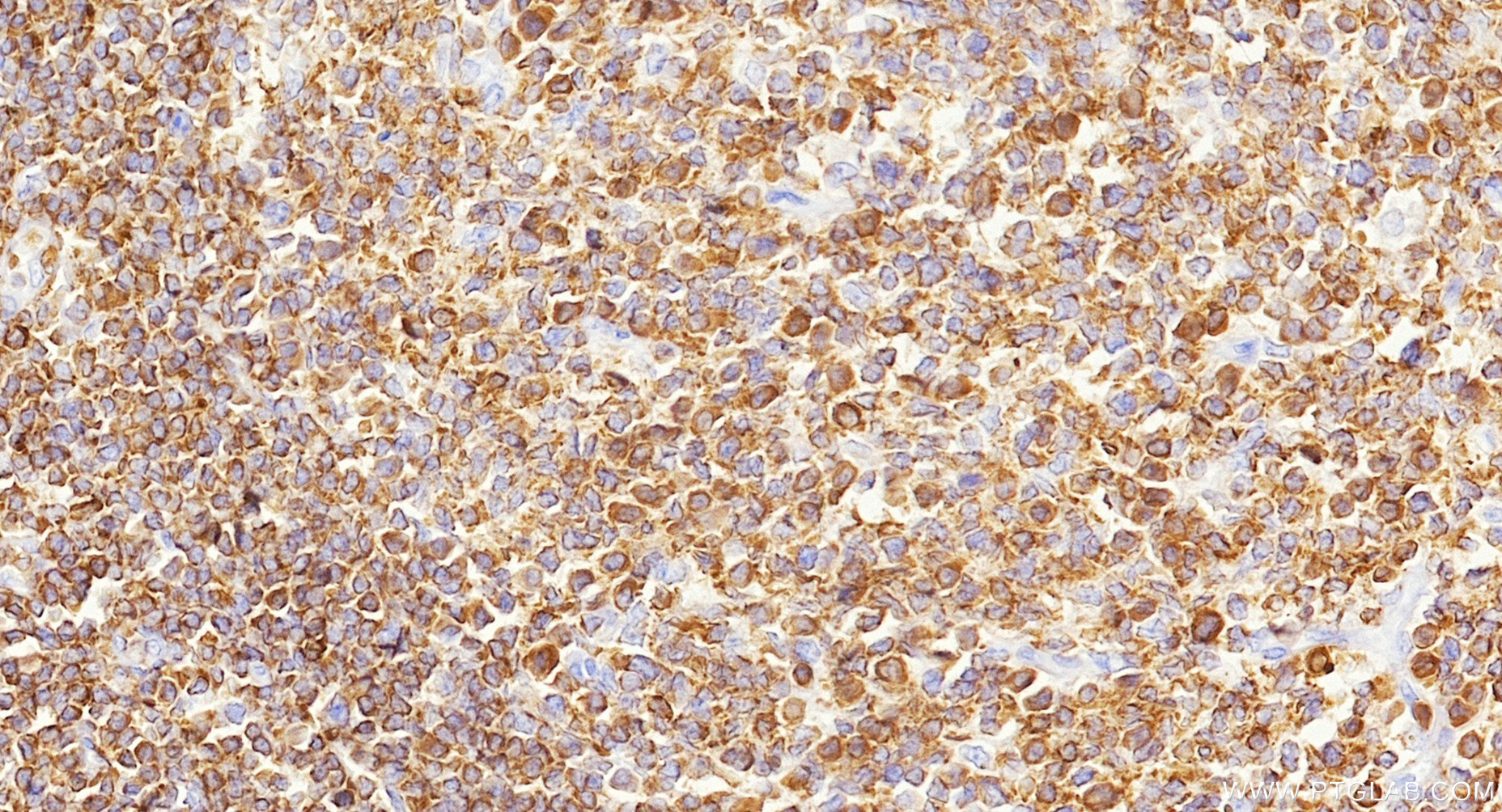 IHC staining of human tonsillitis using Biotin-87378 IHC staining of human tonsillitis using Biotin-87378