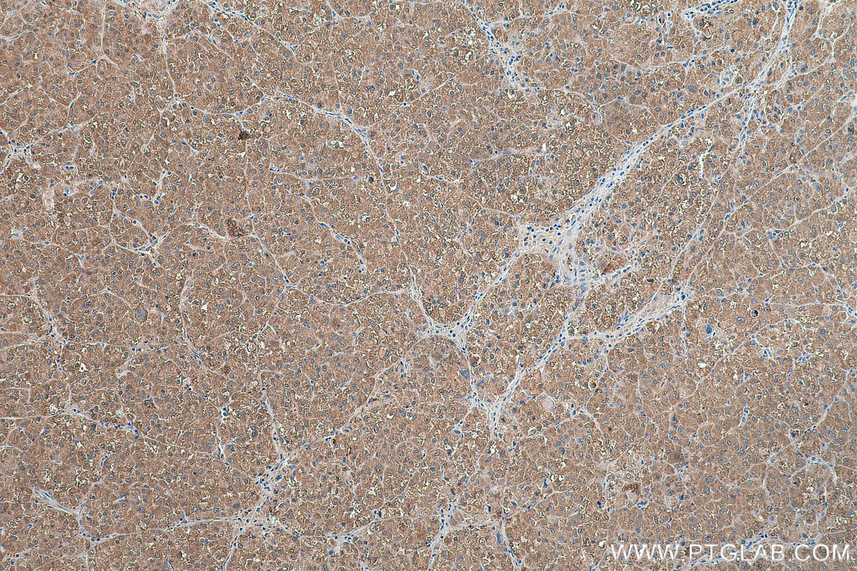 IHC staining of human liver cancer using 18693-1-AP