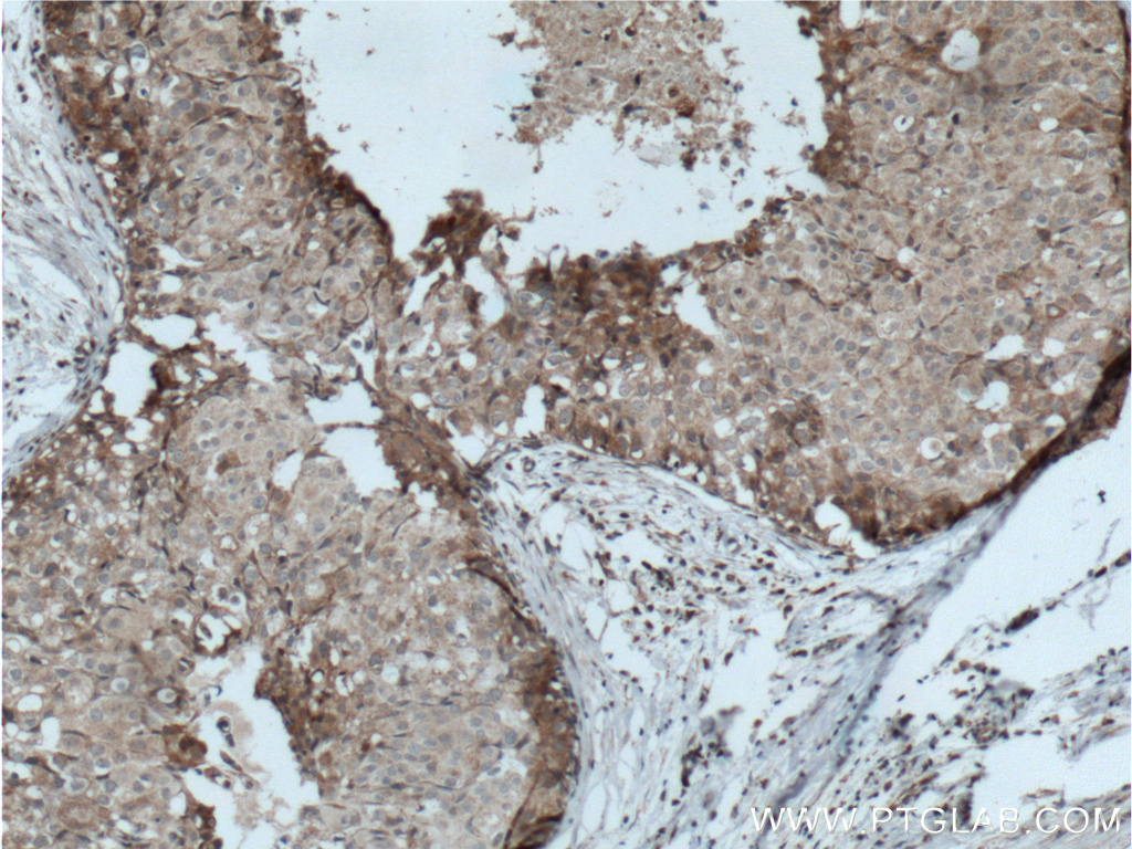 IHC staining of human breast cancer using 22065-1-AP